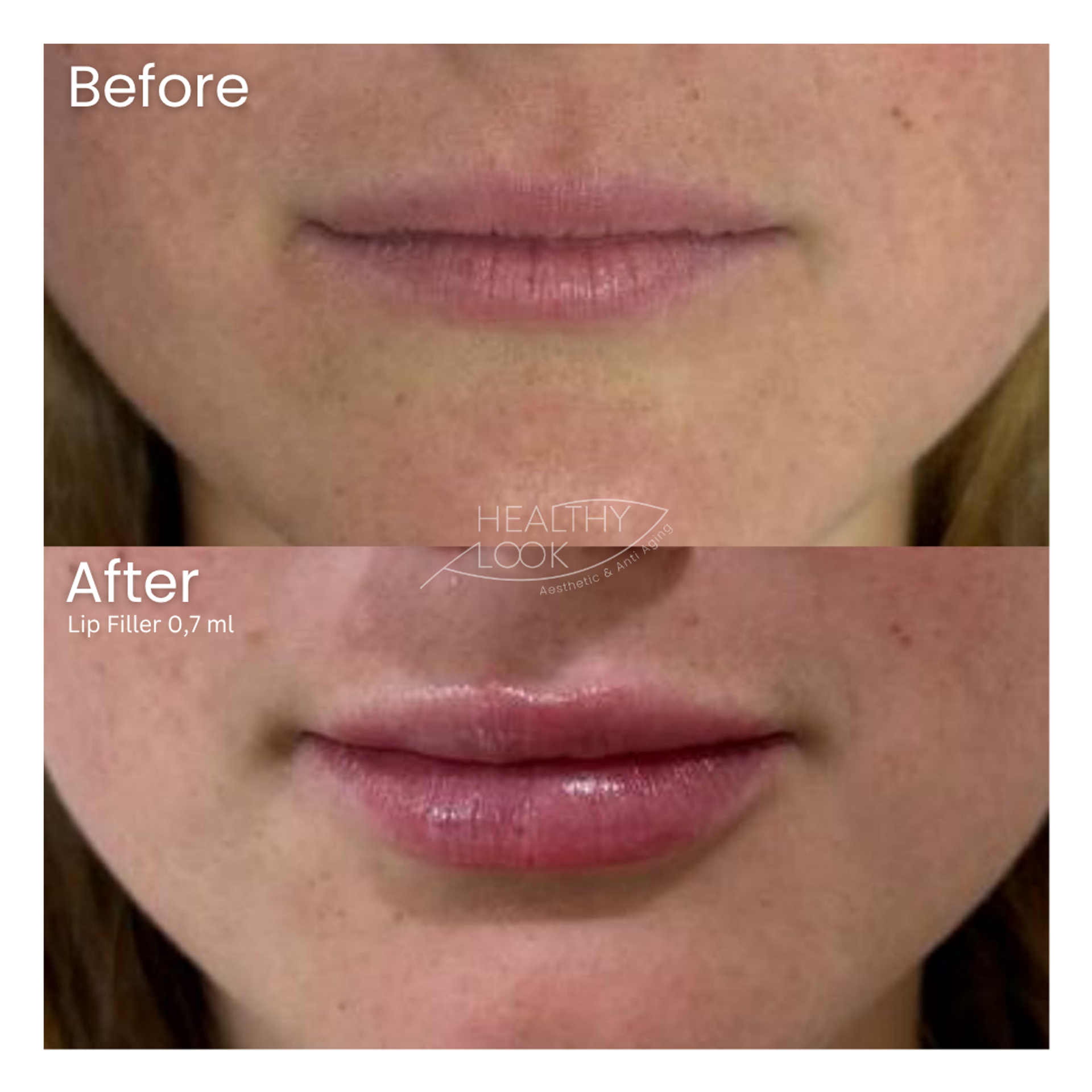 Before and after result 21 for Lip Filler treatment at Healthy Look Aesthetic