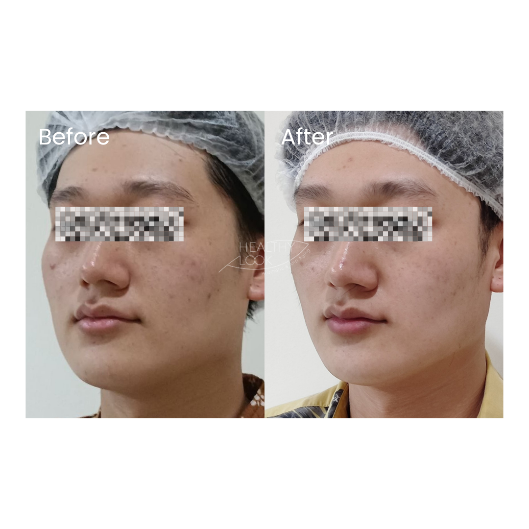Before and after result 6 for Premium HIFU by Linear Z treatment at Healthy Look Aesthetic