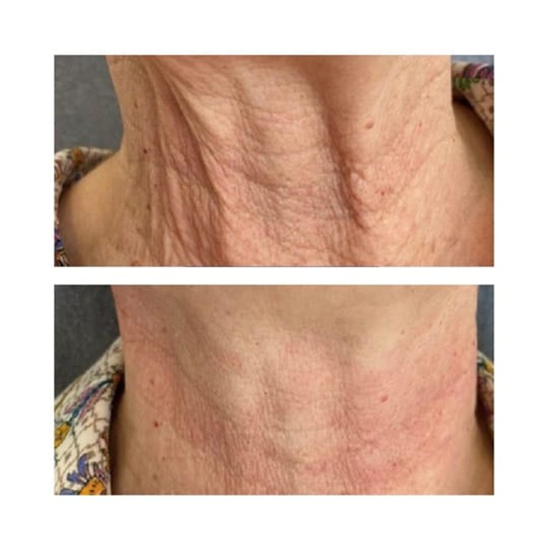 Before and after result 6 for Juvelook treatment at Healthy Look Aesthetic