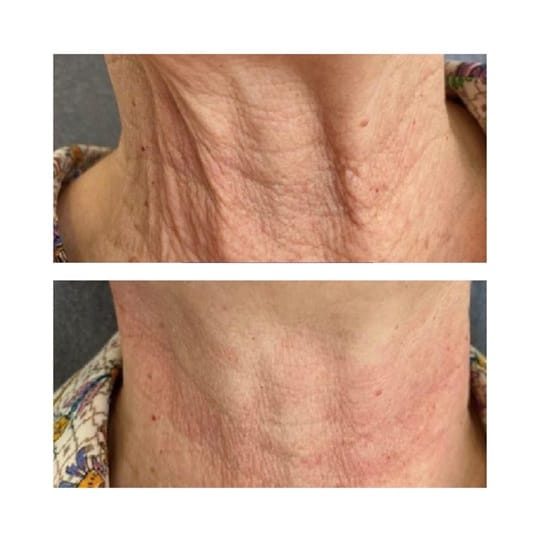Before and after result 6 for Juvelook treatment at Healthy Look Aesthetic