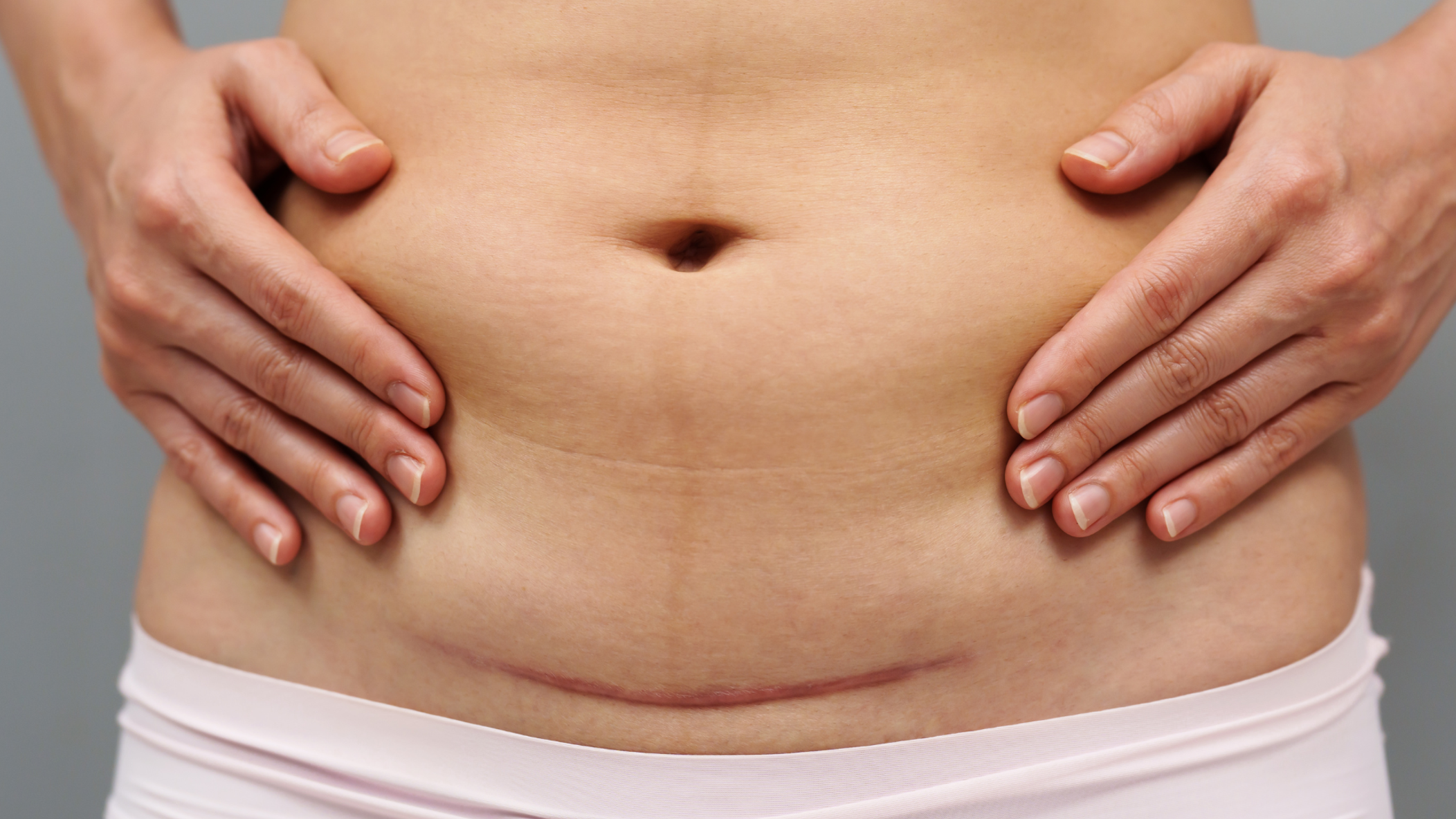Photo of recovering from a Cesarean birth