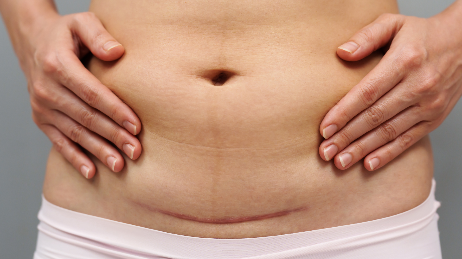 Photo of recovering from a Cesarean birth