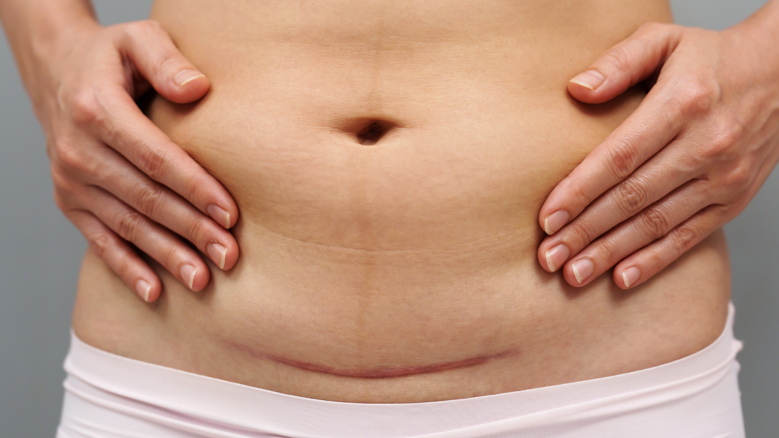 Photo of recovering from a Cesarean birth