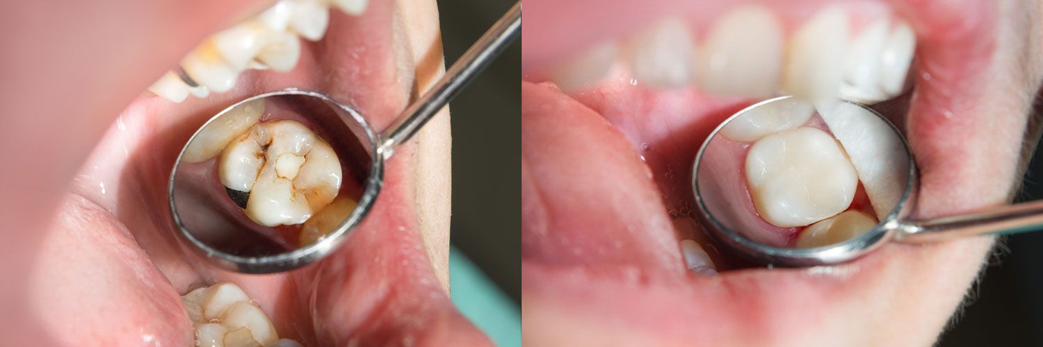 composite tooth colored fillings