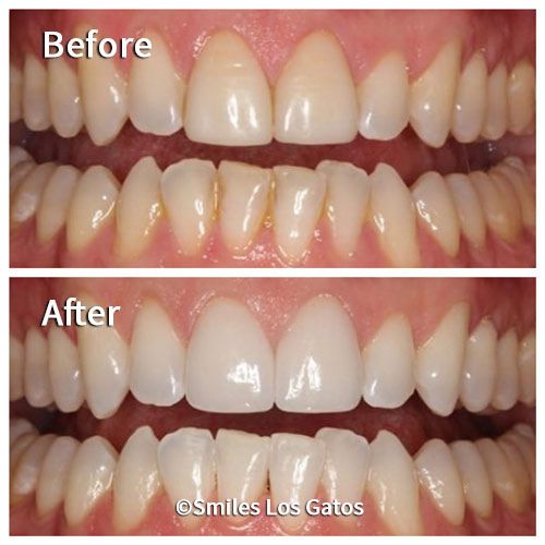 Smile Gallery Los Gatos Smile Makeovers Whiter Teeth