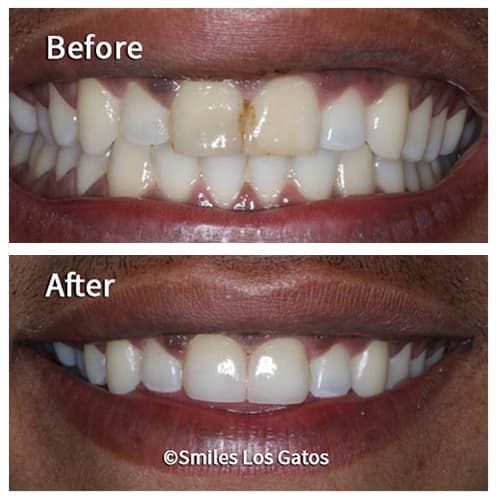 Smile Gallery Los Gatos Smile Makeovers Whiter Teeth