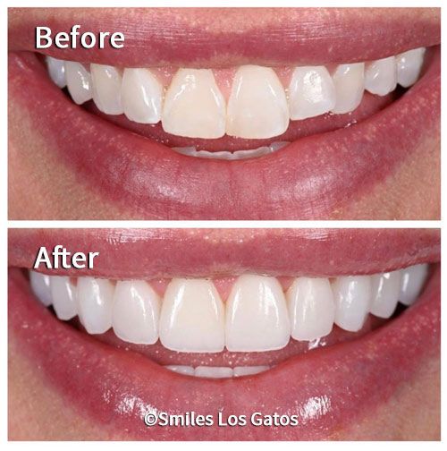 Smile Gallery Los Gatos Smile Makeovers Whiter Teeth