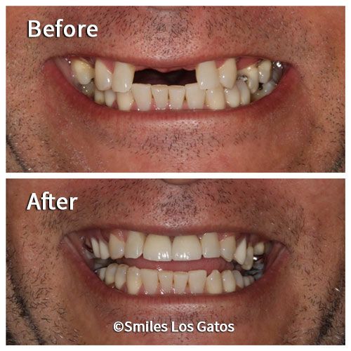 Smile Gallery Los Gatos Smile Makeovers Whiter Teeth