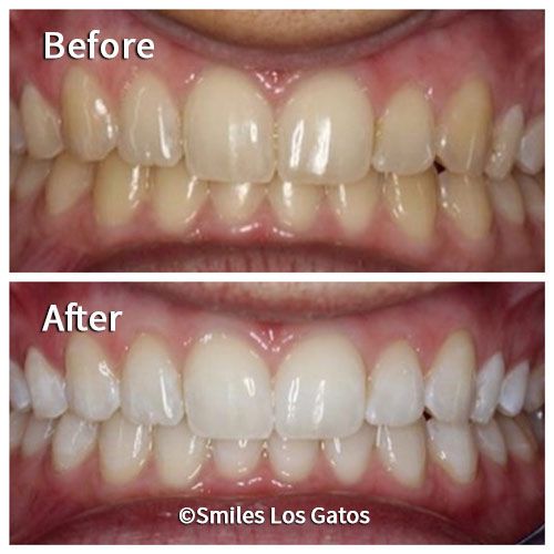 Smile Gallery Los Gatos Smile Makeovers Whiter Teeth