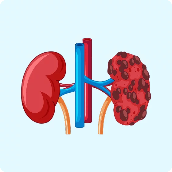 Chronic kidney disease treatment consultation