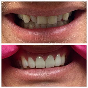 before and after teeth alignment