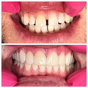 before and after closing teeth gap