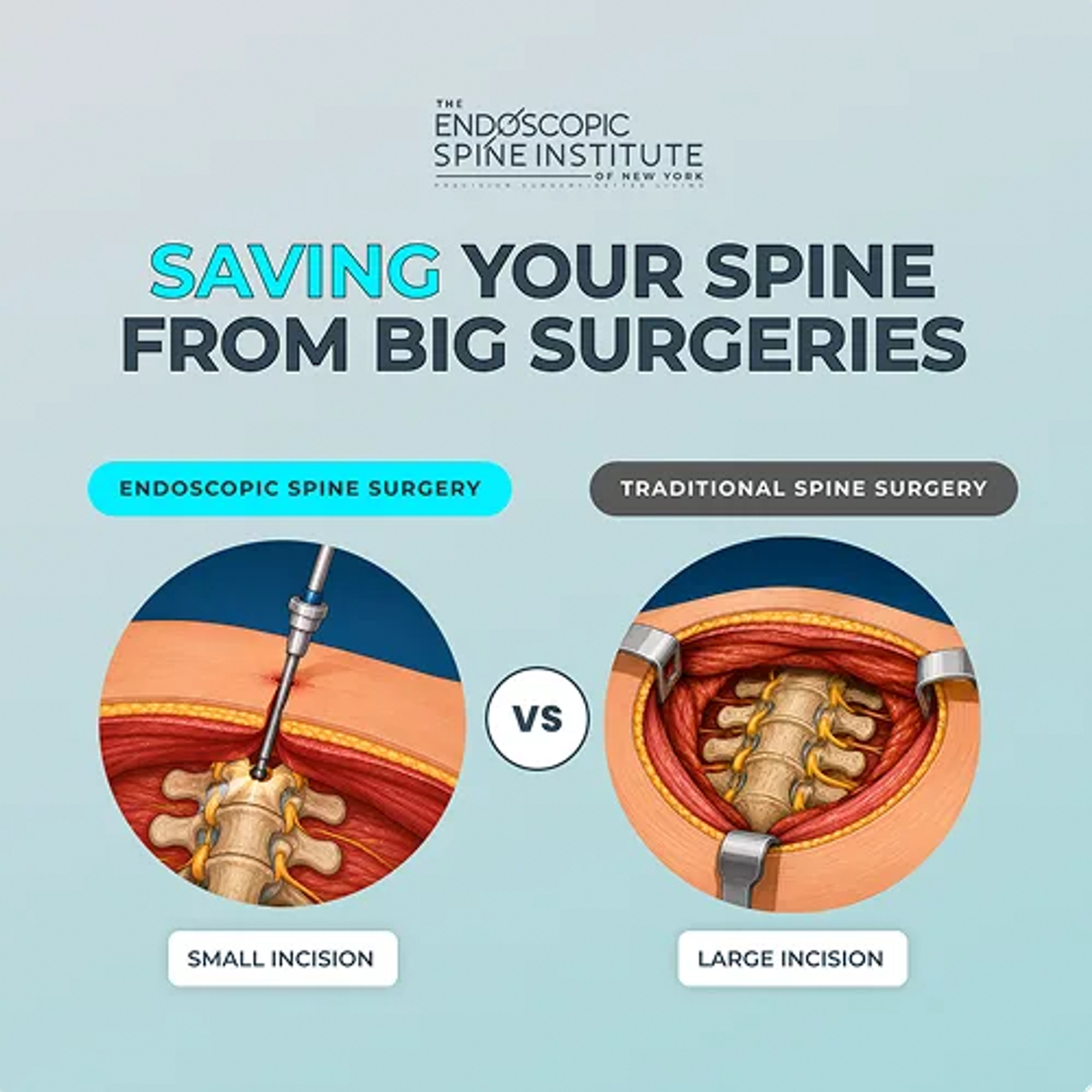 What Is Endoscopic Spine Surgery?