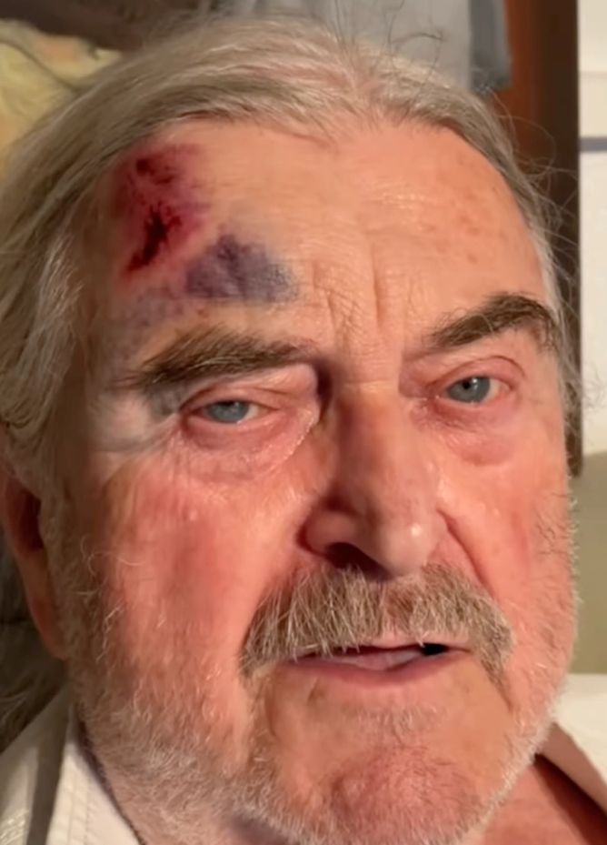 Zkrvavený František Ringo Čech přiznal: Pravdu o monoklu nečekal nikdo Zkrvavený František Ringo Čech přiznal: Pravdu o monoklu nečekal nikdo