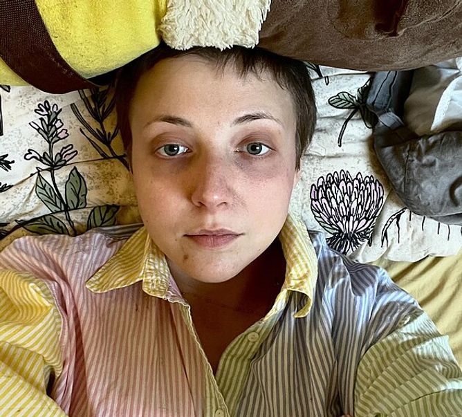 Anička Slováčková po chemoterapii. Anička Slováčková po chemoterapii.