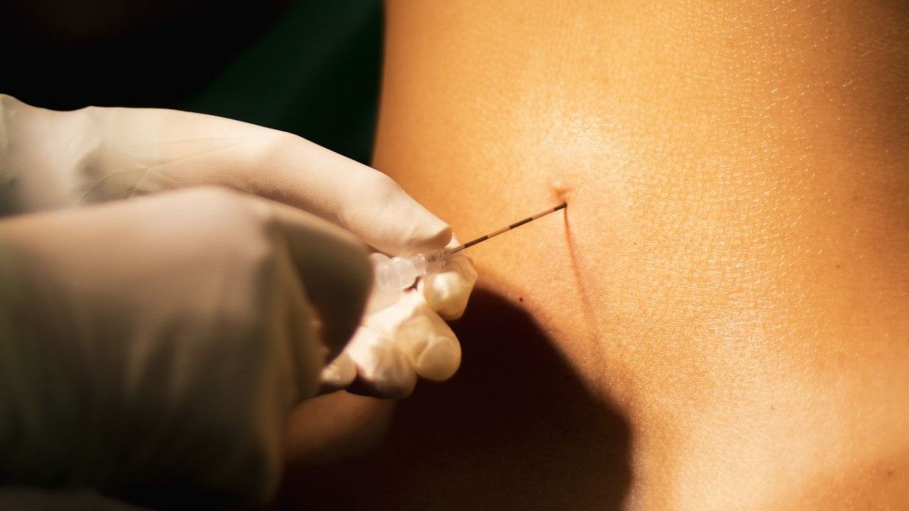 Nerve Damage or Paralysis After an Epidural in New Jersey When Could It Be Medical Malpractice.jpg