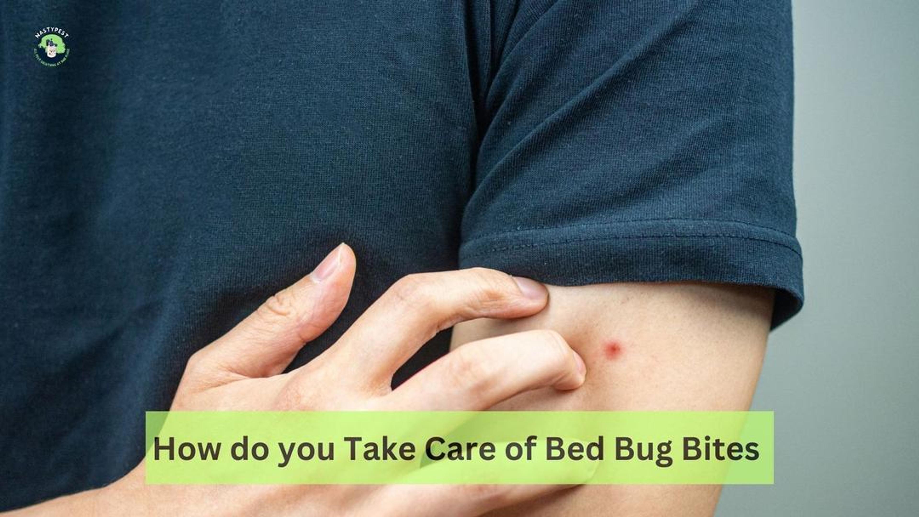 How do you Take Care of Bed Bug Bites