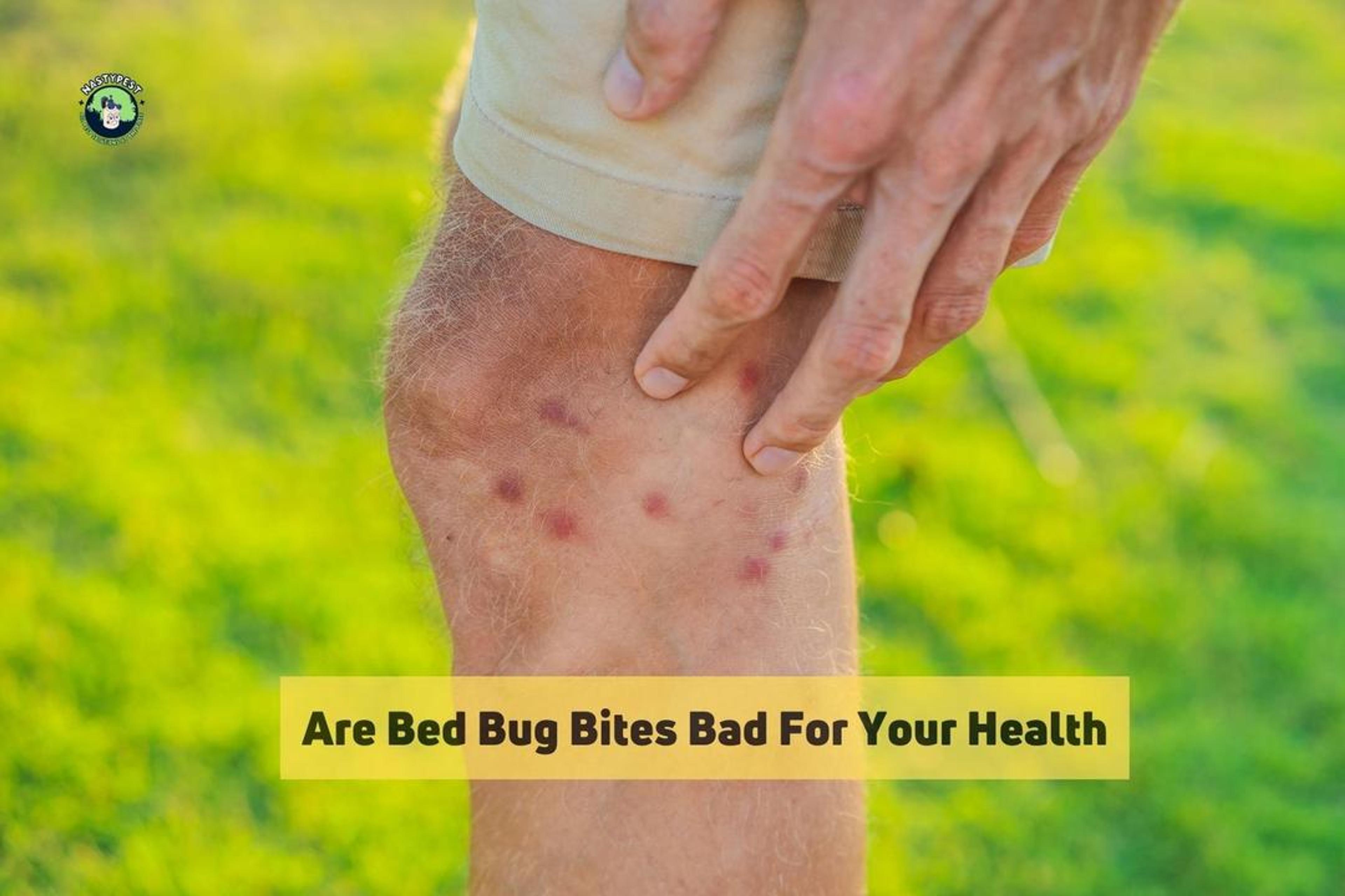 Are Bed Bug Bites Bad For Your Health