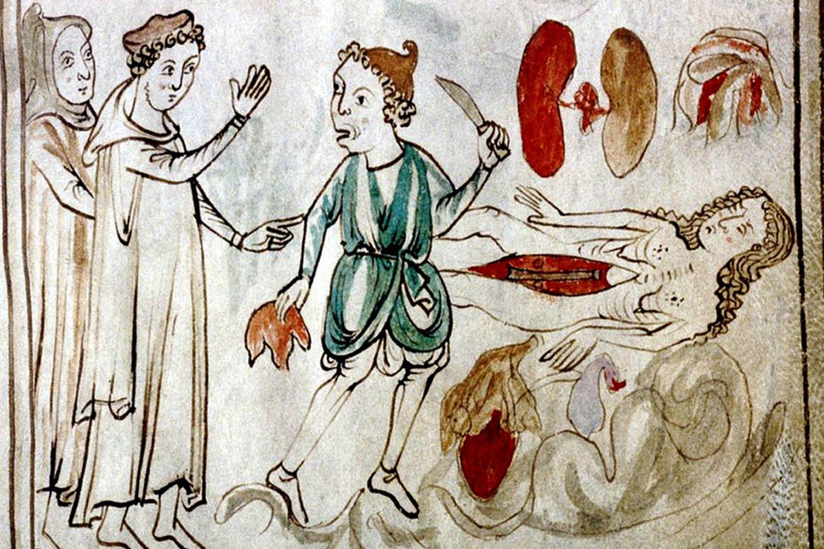 13th century illustration of the dissection of a cadaver.