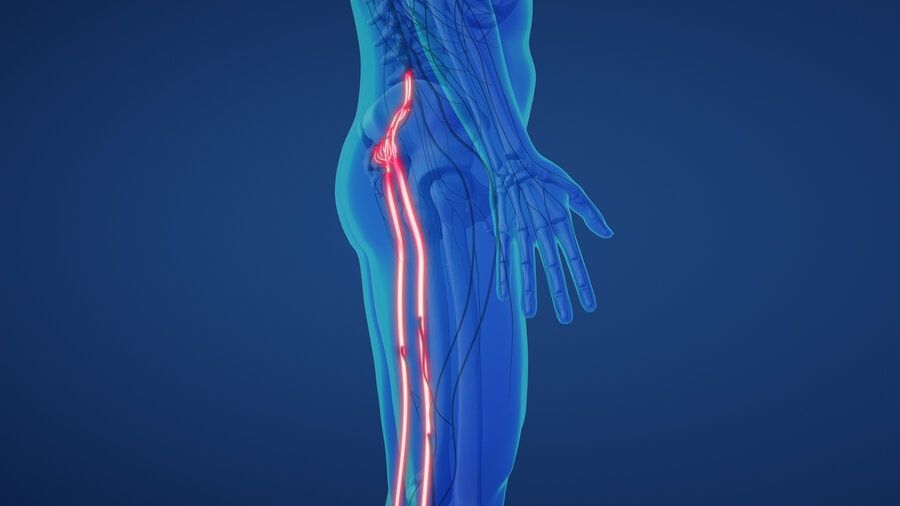 Graphic showing sciatica pain starting in sciatic nerve and traveling down leg