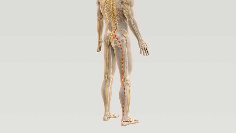 Graphic shows sciatica pain starting in lower back and radiating down leg