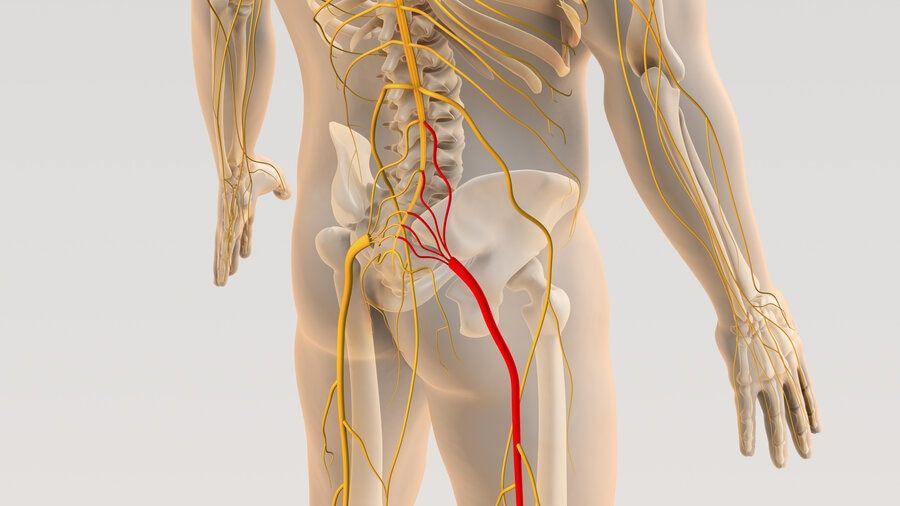 Graphic showing sciatica pain shooting from sciatica down the leg