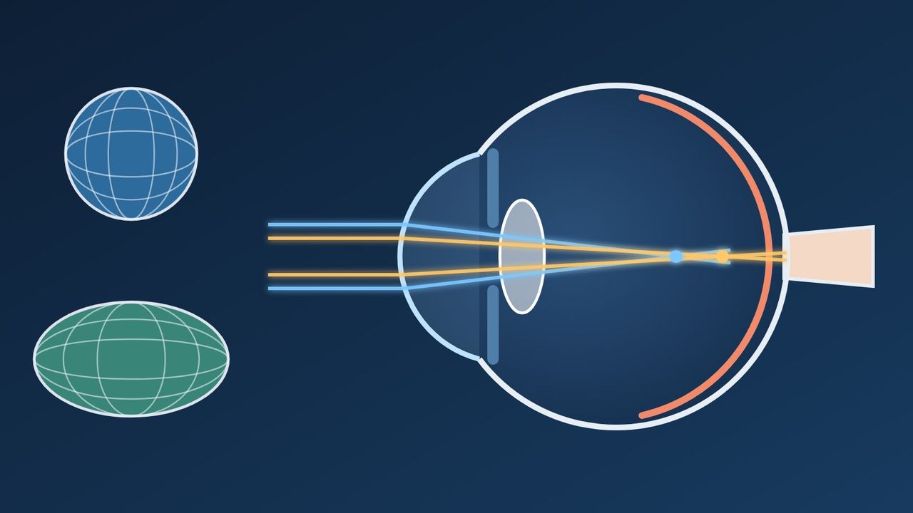 Schéma d'un œil en coupe : deux points de focalisation en avant de la rétine, à côté d'une sphère et d'un ellipsoïde
