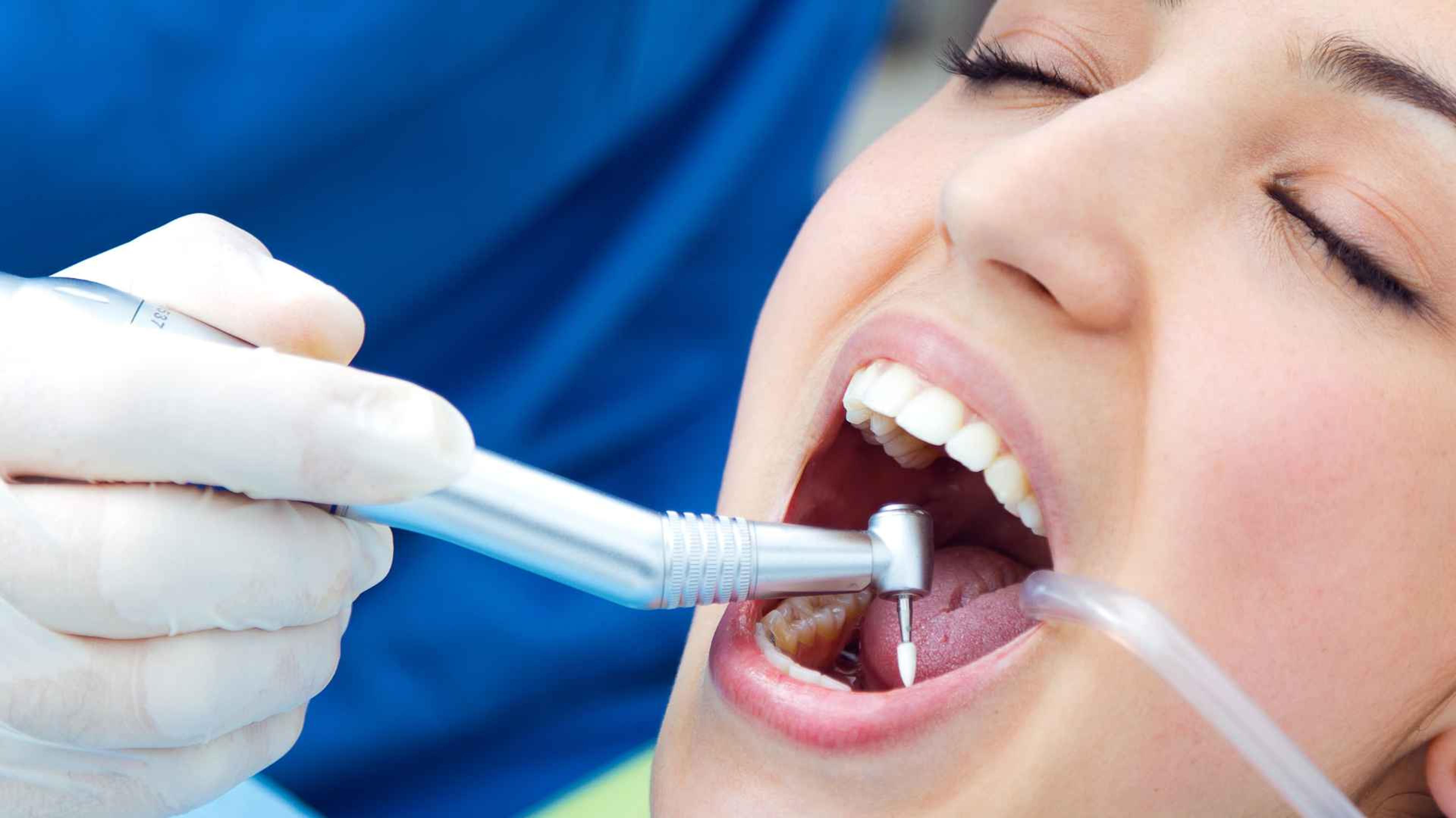 Remineralización dental: qué es, cómo funciona y por qué es clave para los pacientes