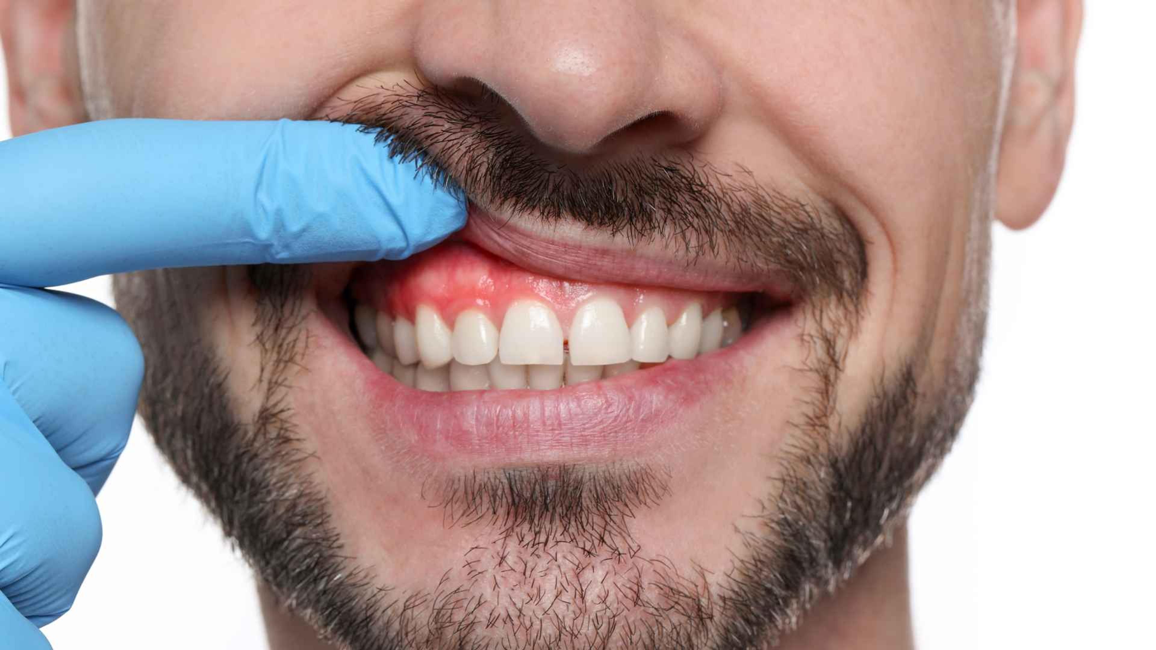 Injerto de encía: Qué es, cuándo se necesita y cómo es el tratamiento