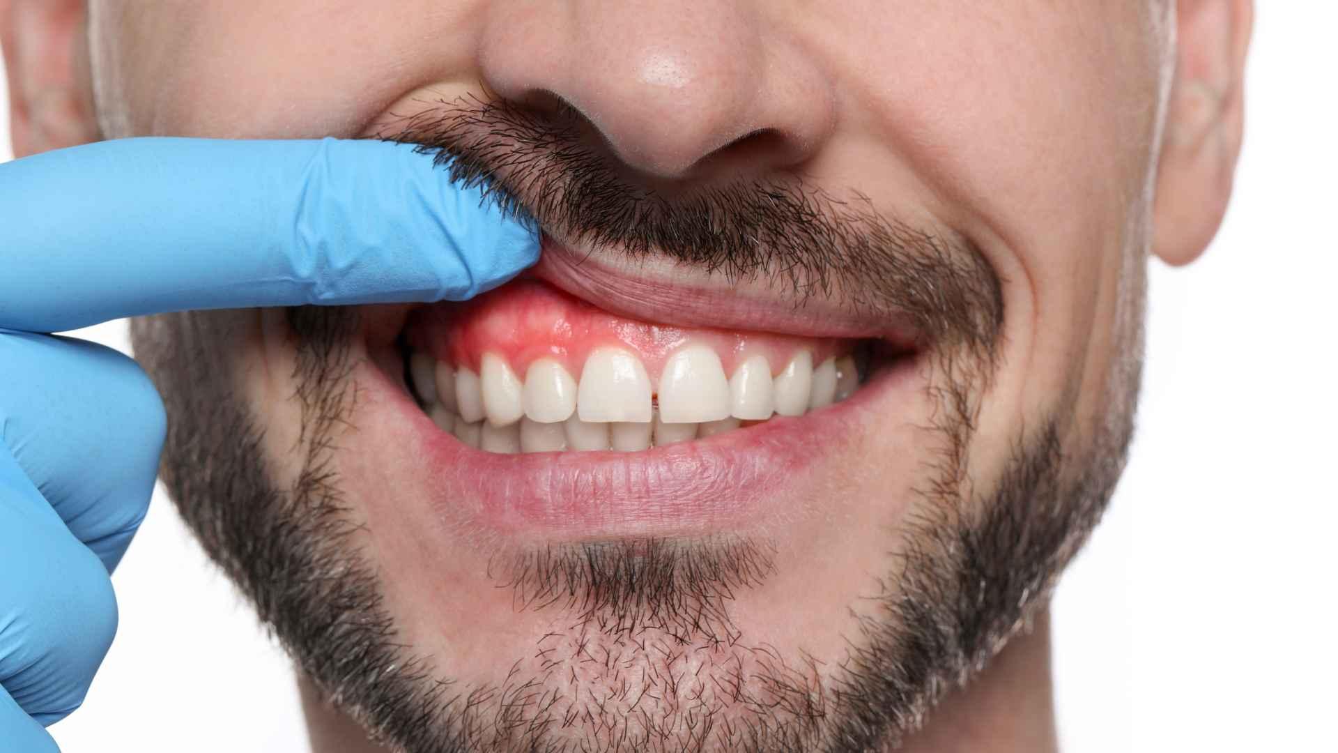 Injerto de encía: Qué es, cuándo se necesita y cómo es el tratamiento