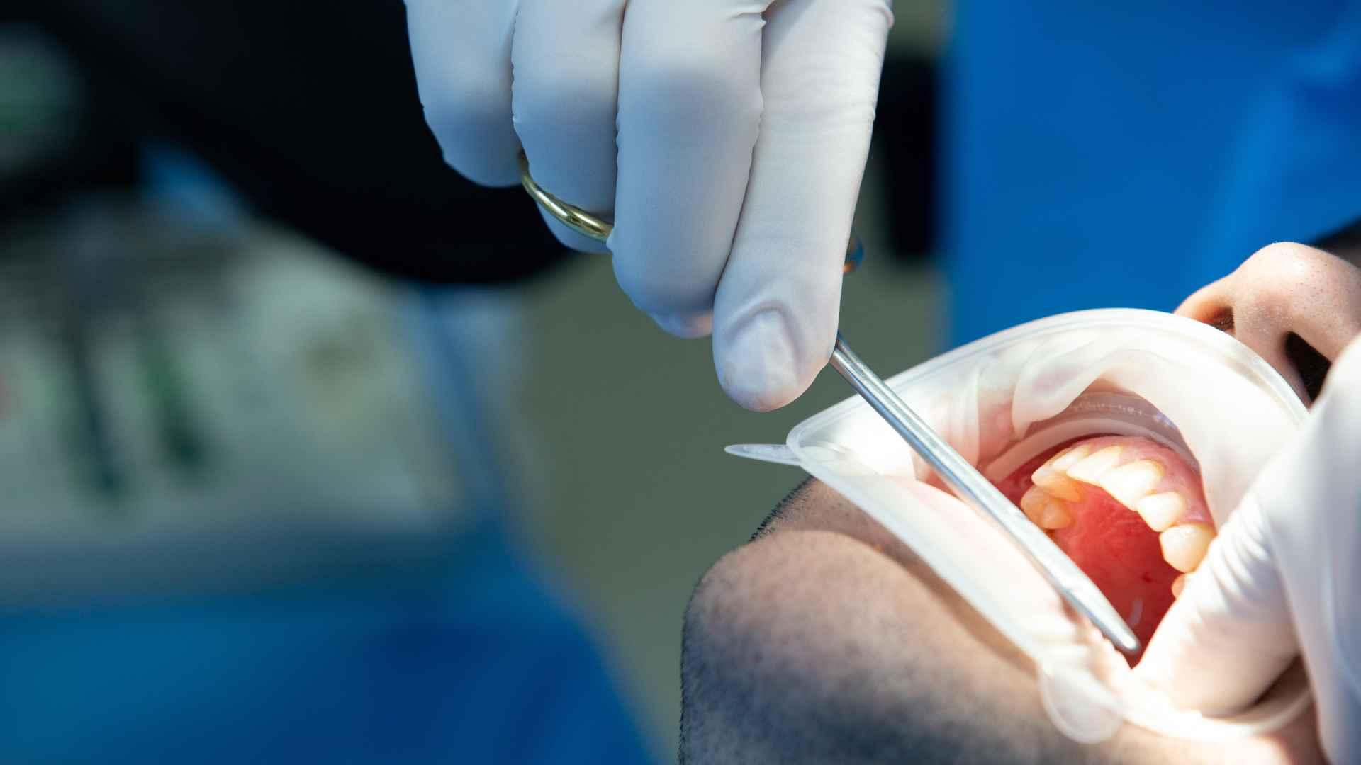 Odontosección: Guía completa del procedimiento y cuándo es necesaria