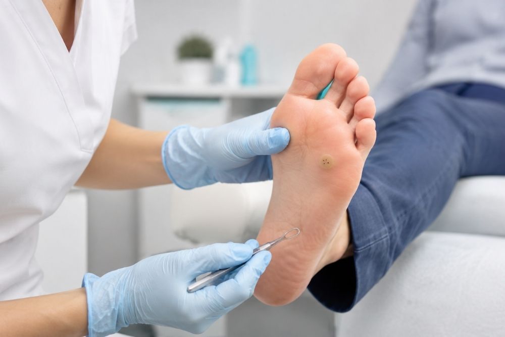 Papiloma en el pie / Clínica de fisioterapia Recupérate