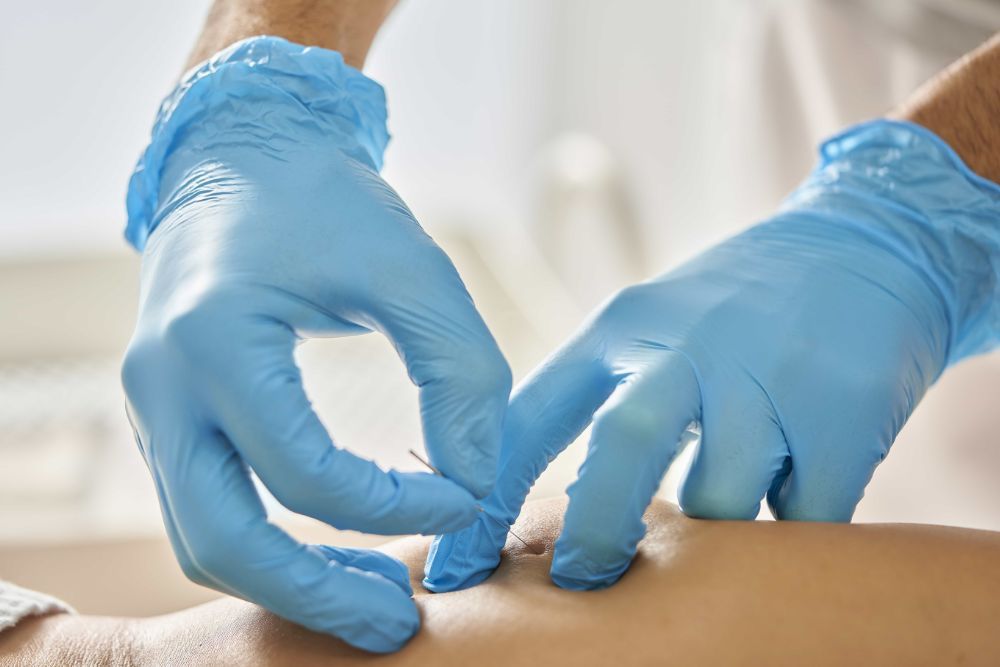 Punción seca en la fisioterapia | Clínica Recupérate en Salamanca