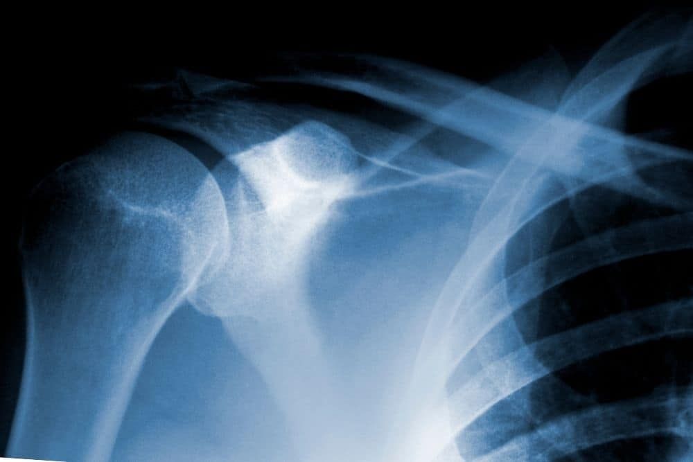 Tratamiento para la calcificación en el hombro | Clínica Recupérate en Salamanca