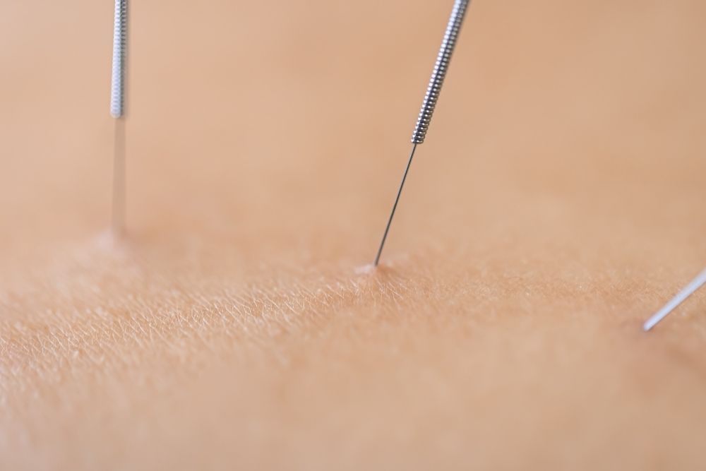 ¿Para qué sirve la punción seca en fisioterapia? | Clínica Recupérate en Salamanca