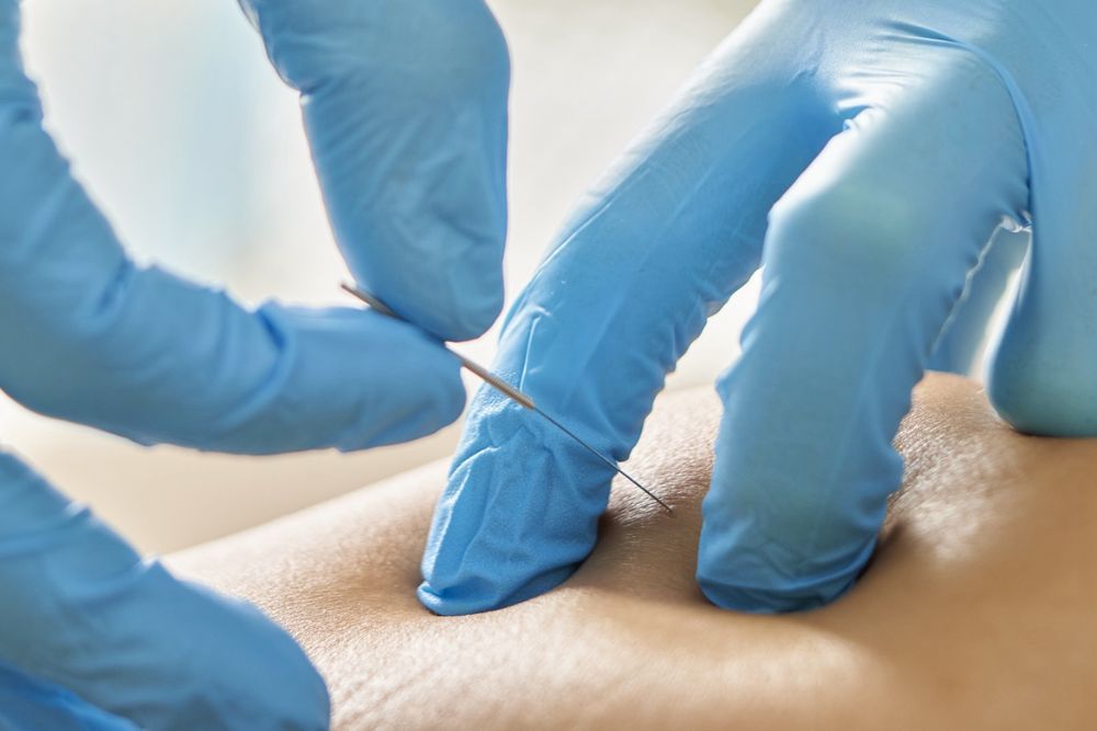 Punción seca en Salamanca — tratamiento invasivo en Clínica Recupérate
