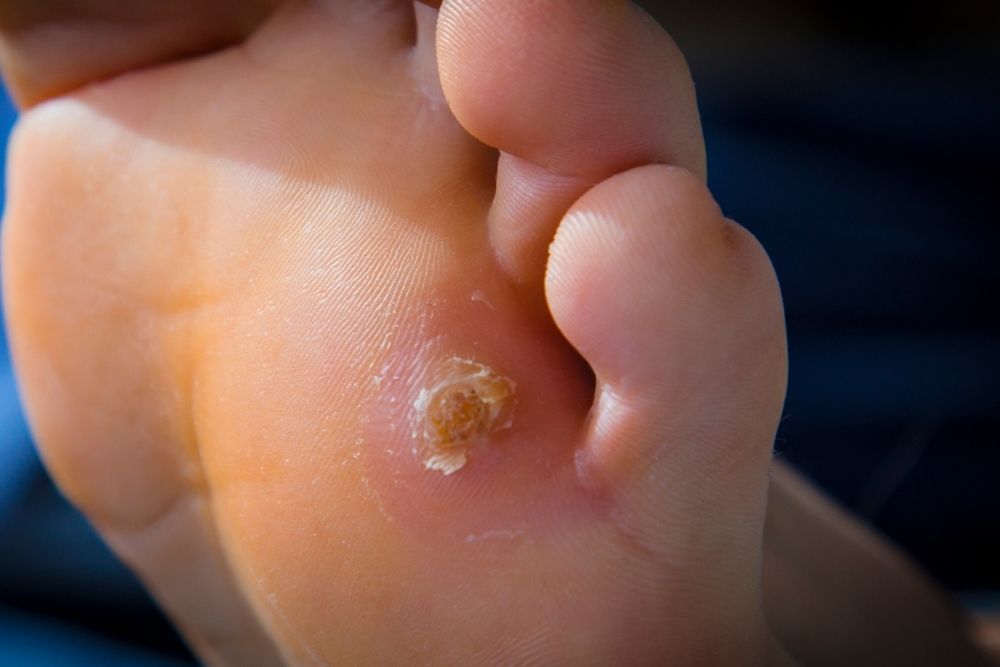 Tratamiento de callos en los pies