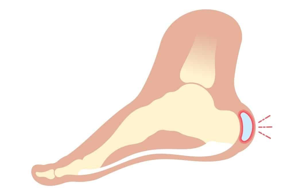 Tratamiento de fisioterapia en la sinovitis: cómo reducir la inflamación y recuperar la movilidad | Clínica Recupérate en Salamanca