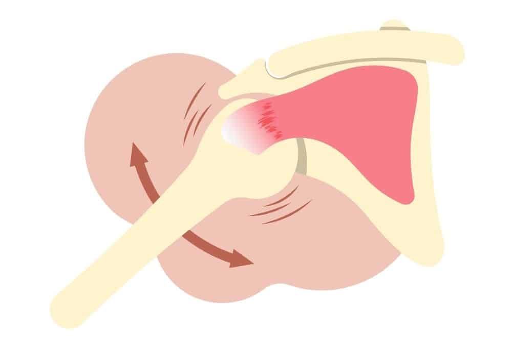 Tratamiento para la capsulitis en el hombro: cómo aliviar el dolor y recuperar la movilidad | Clínica Recupérate en Salamanca