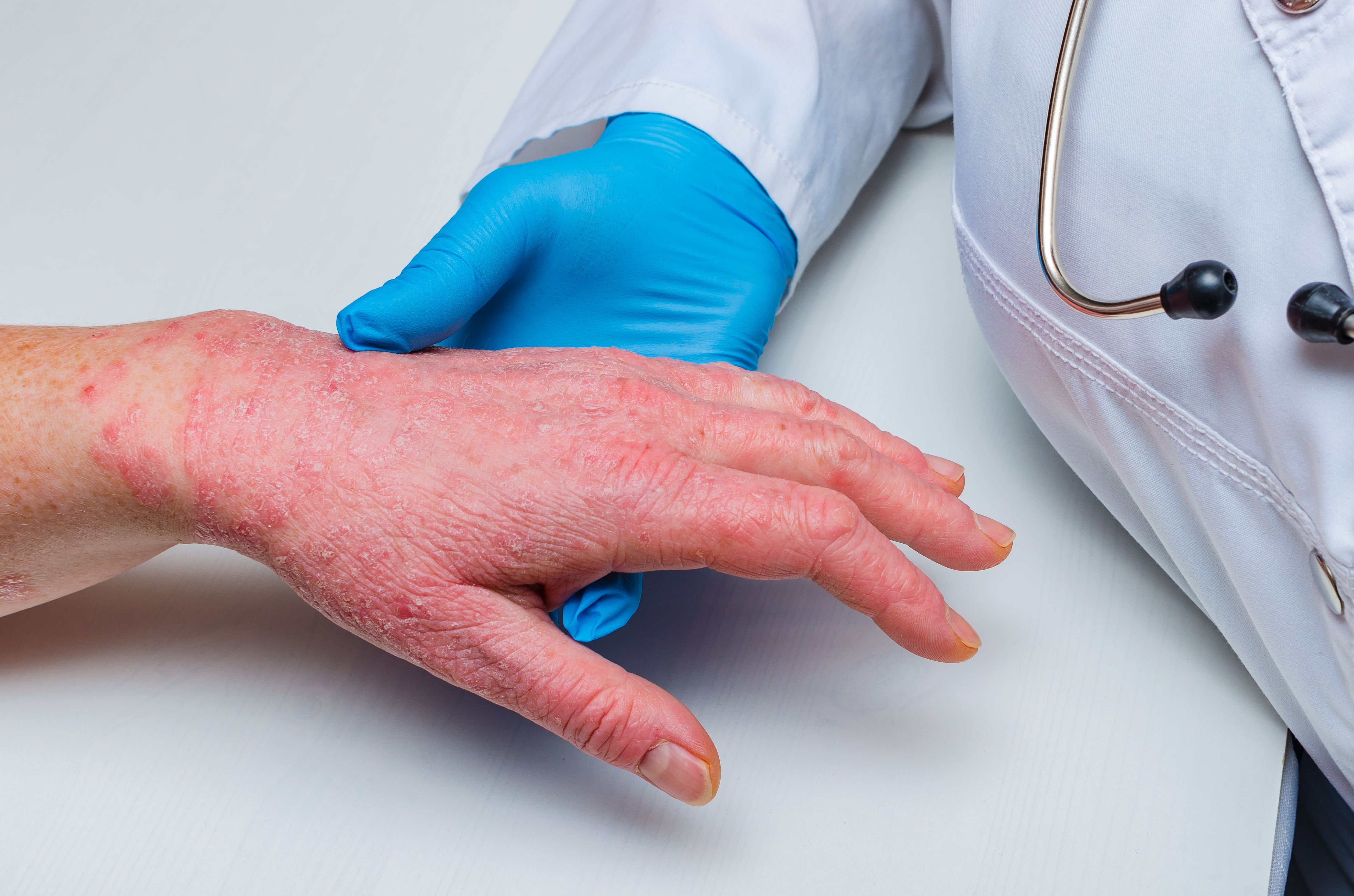 Welche Beschwerden kann Psoriasis verursachen?