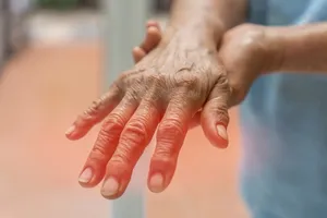 Cannabis bei Polyneuropathie: Linderung neuropathischer Schmerzen