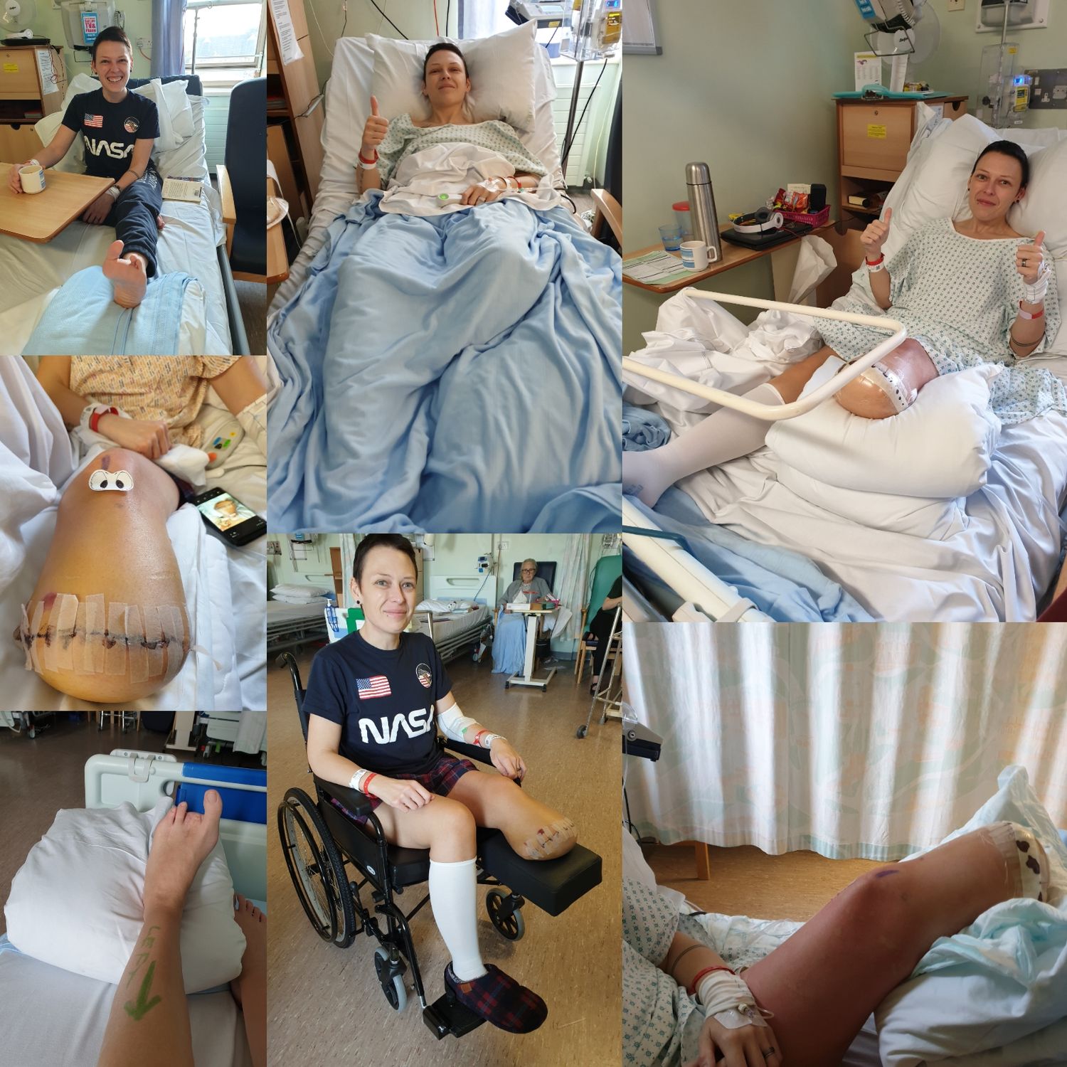 Photos taken before and after my surgery.