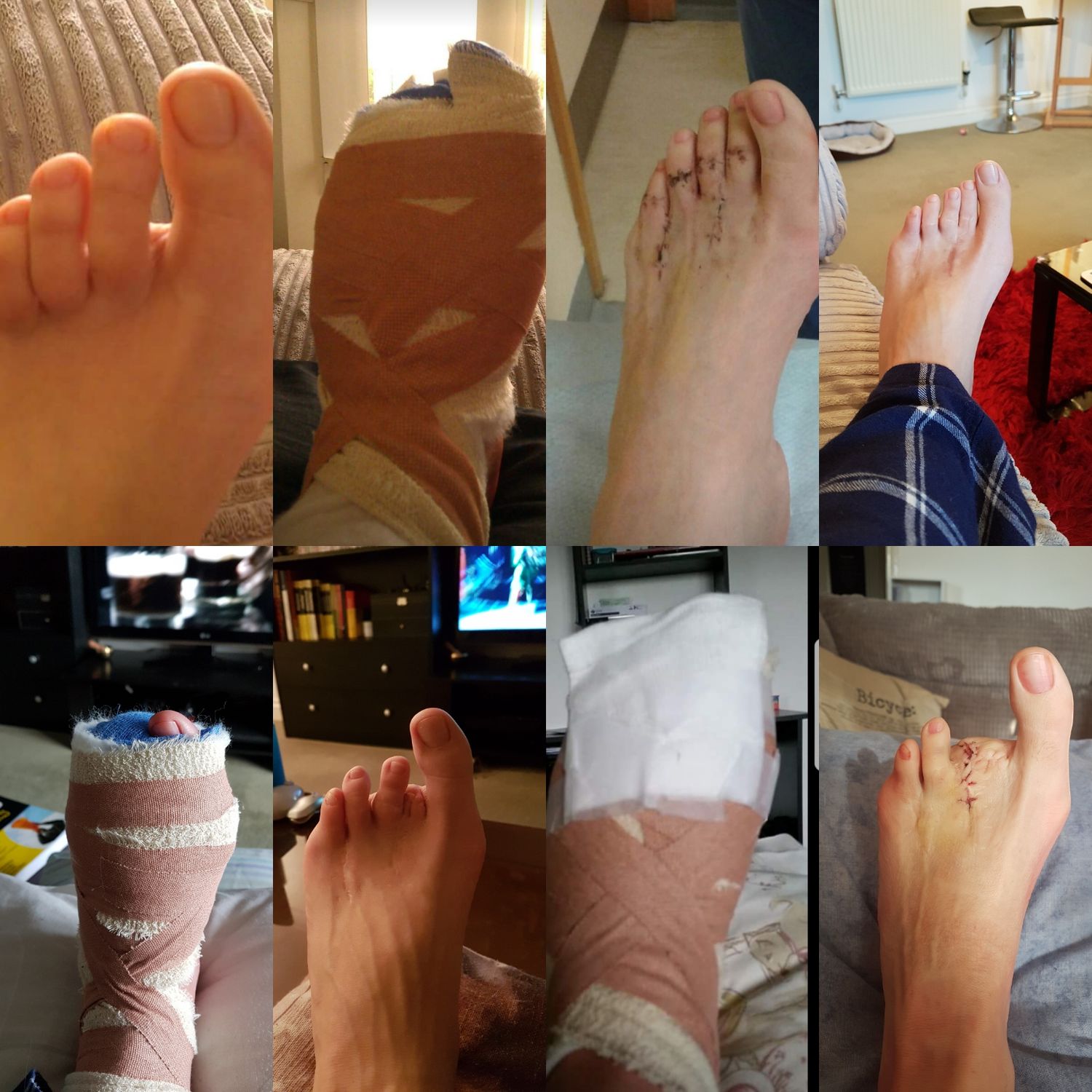 The stages of my foot decline 😁