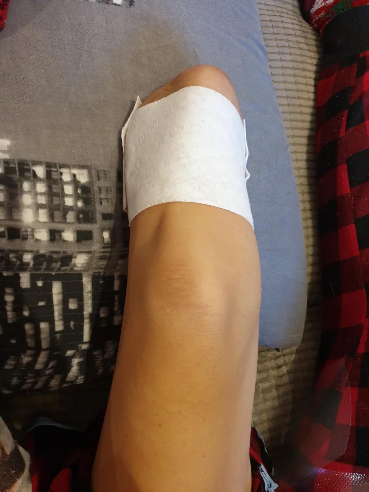 Stumpey trying local anaesthetic plasters….diddnt work, but it was worth a go 😊