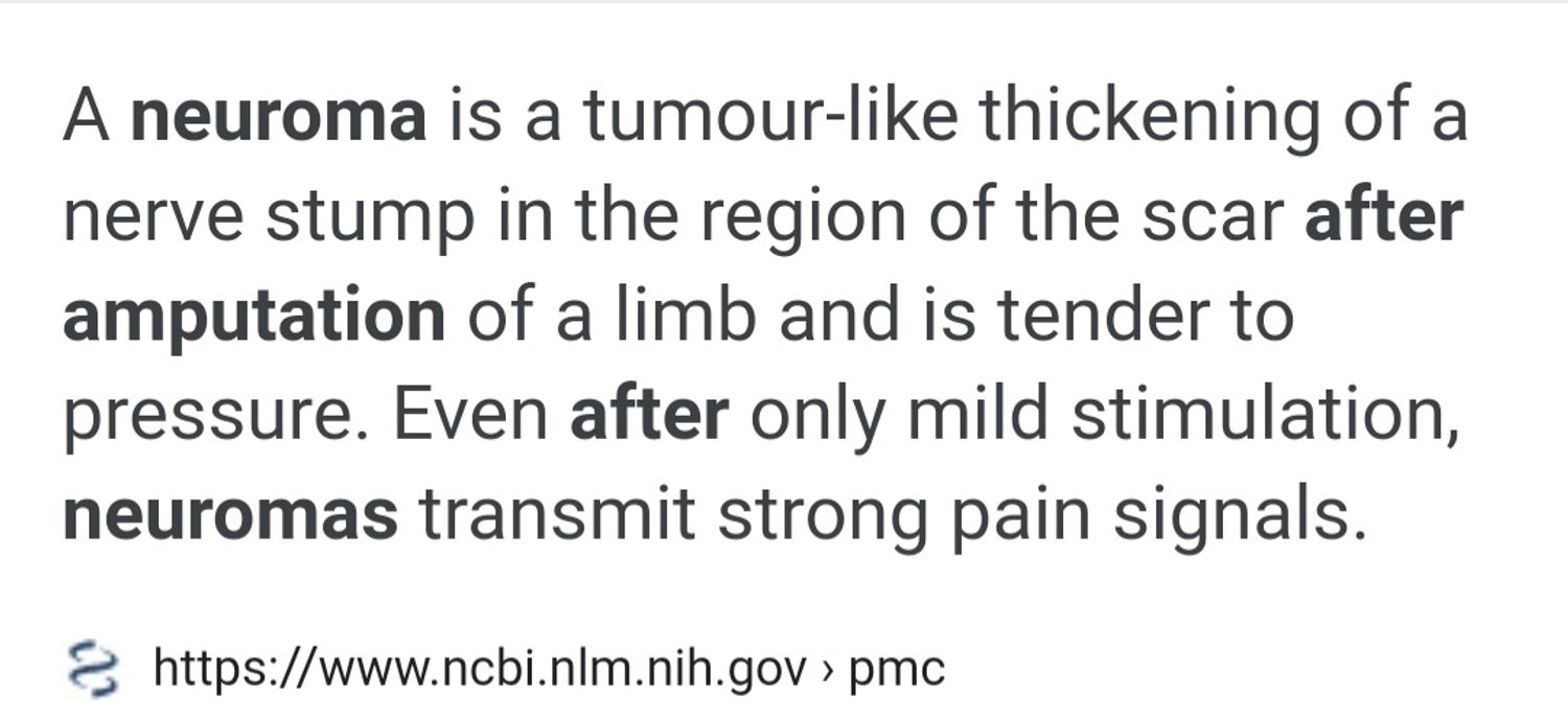 neuroma is a tumor-like thickening of a nerve stump