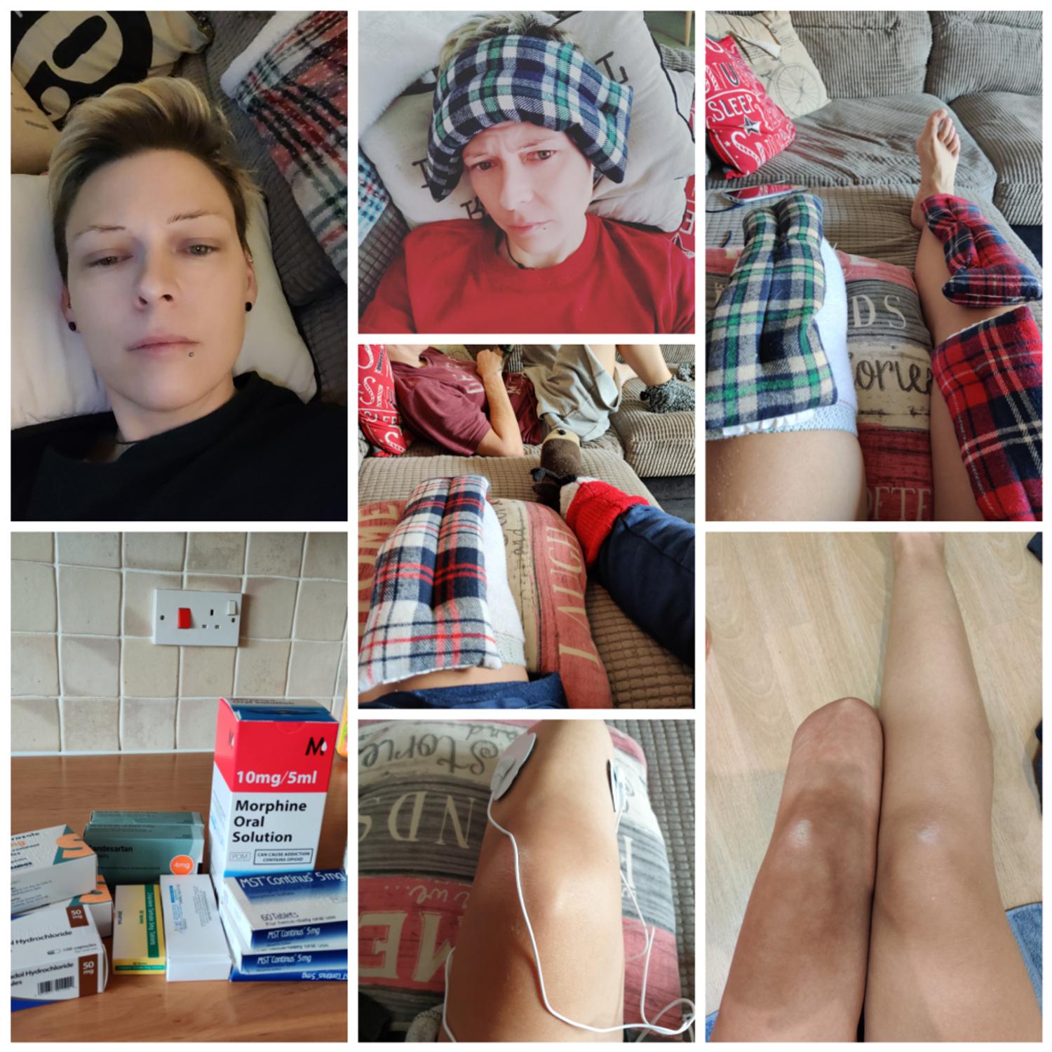 What crps look’s like! I’ve always been against showing stumpey, but to show people is to help them understand. I am not ashamed of stumpey!