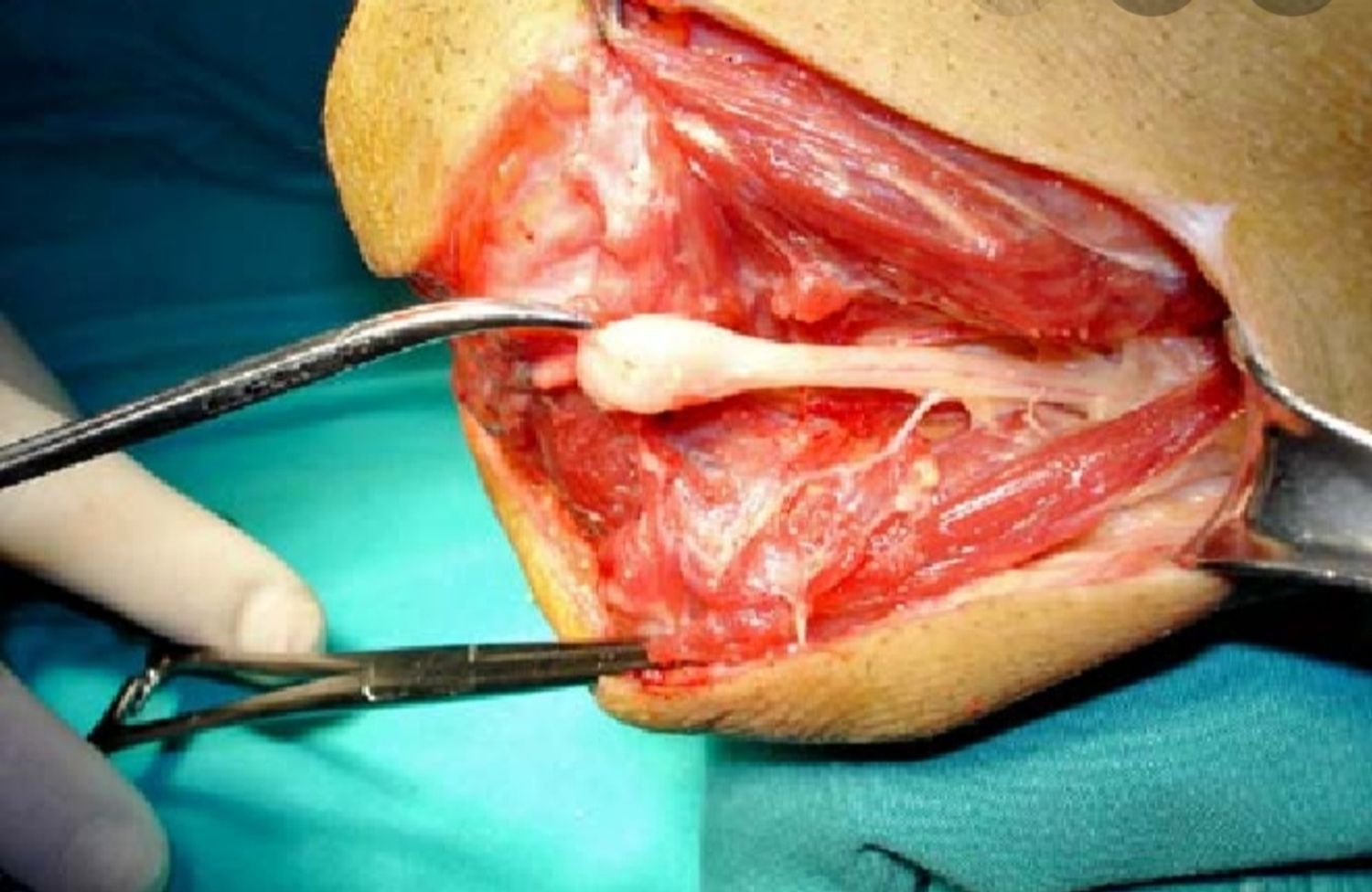 picture of a neuroma