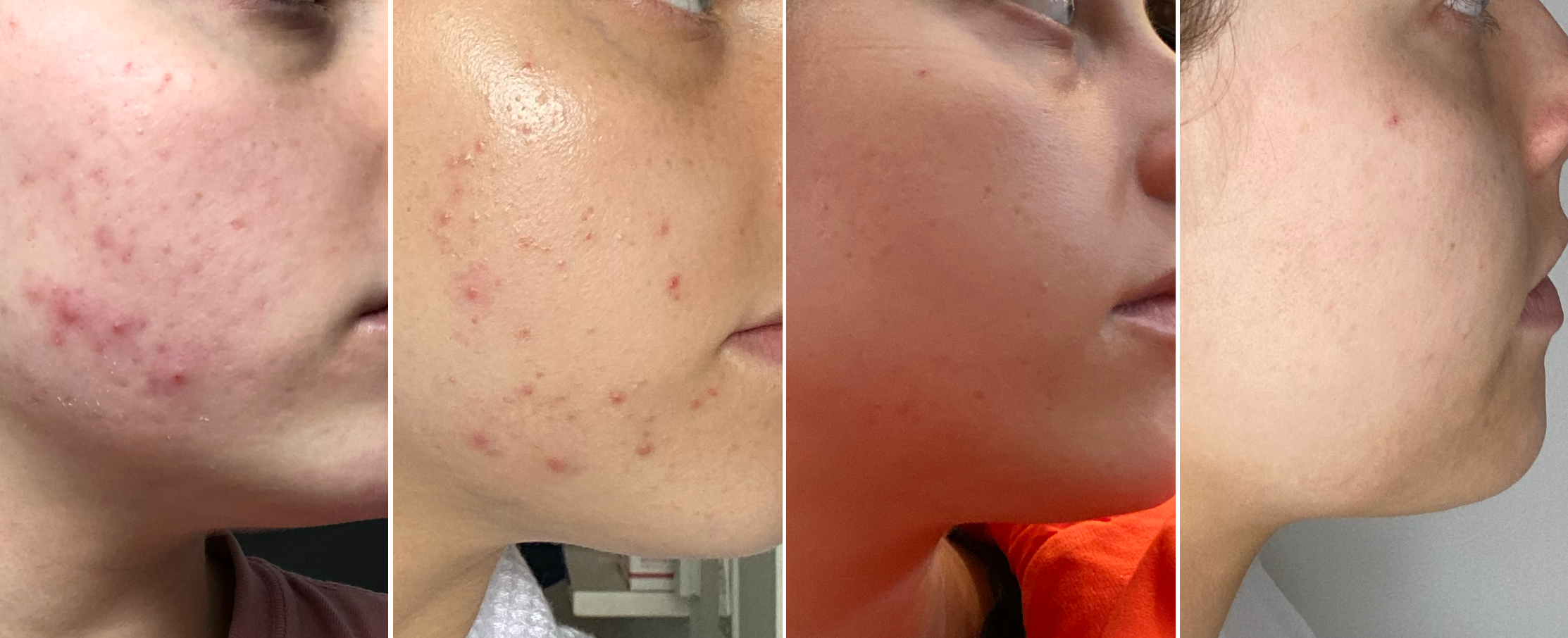 Eleanor’s progress with acne: getting clearer and calmer by the month