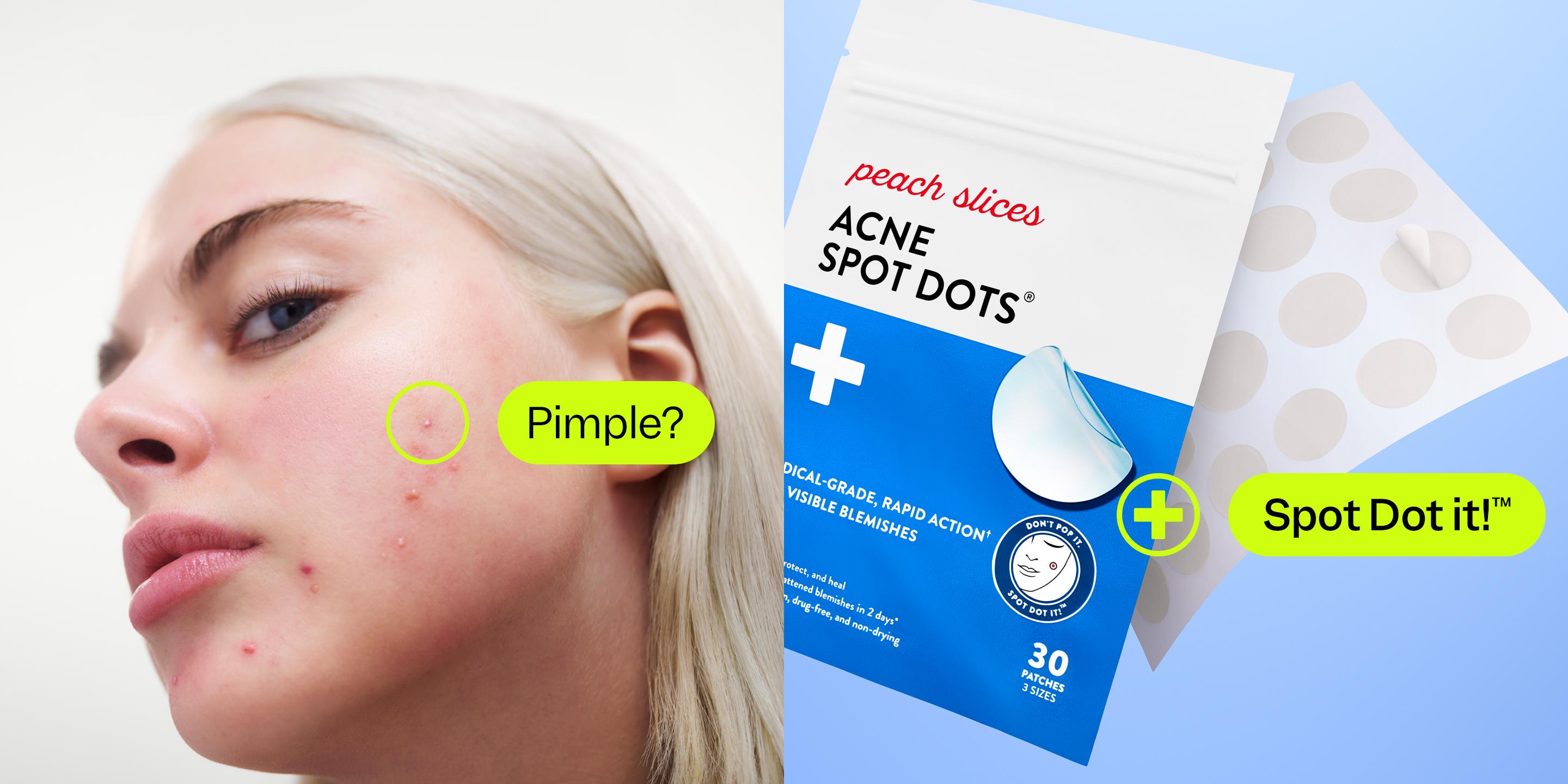 Peach Slices Acne Spot Dots perfect for overnight use