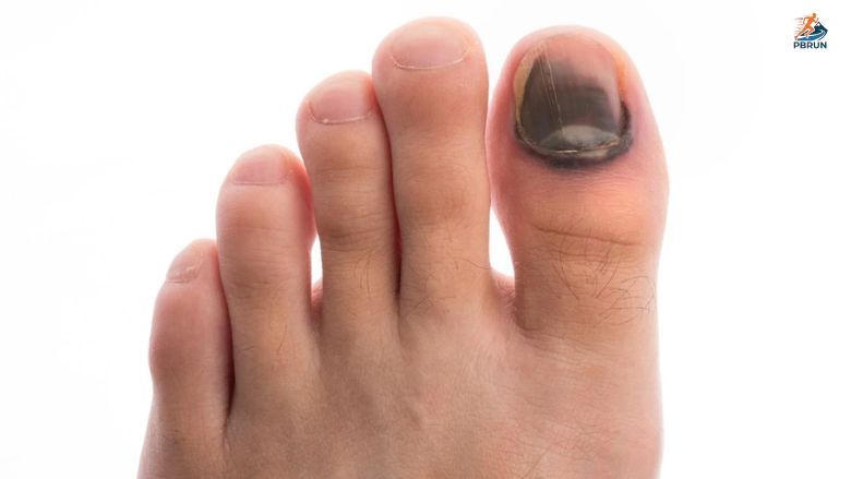 Hiện tượng móng chân bị thâm đen khi chạy bộ